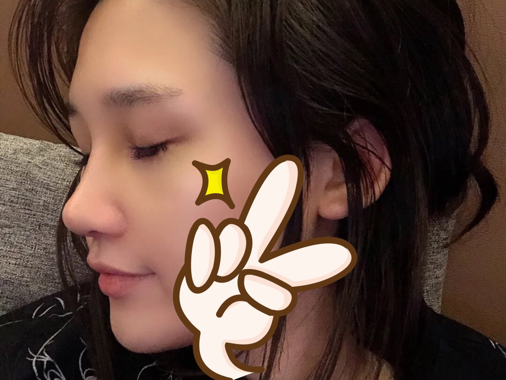 以前的鼻子惨不忍睹,丑鼻子里最不上镜的那种.