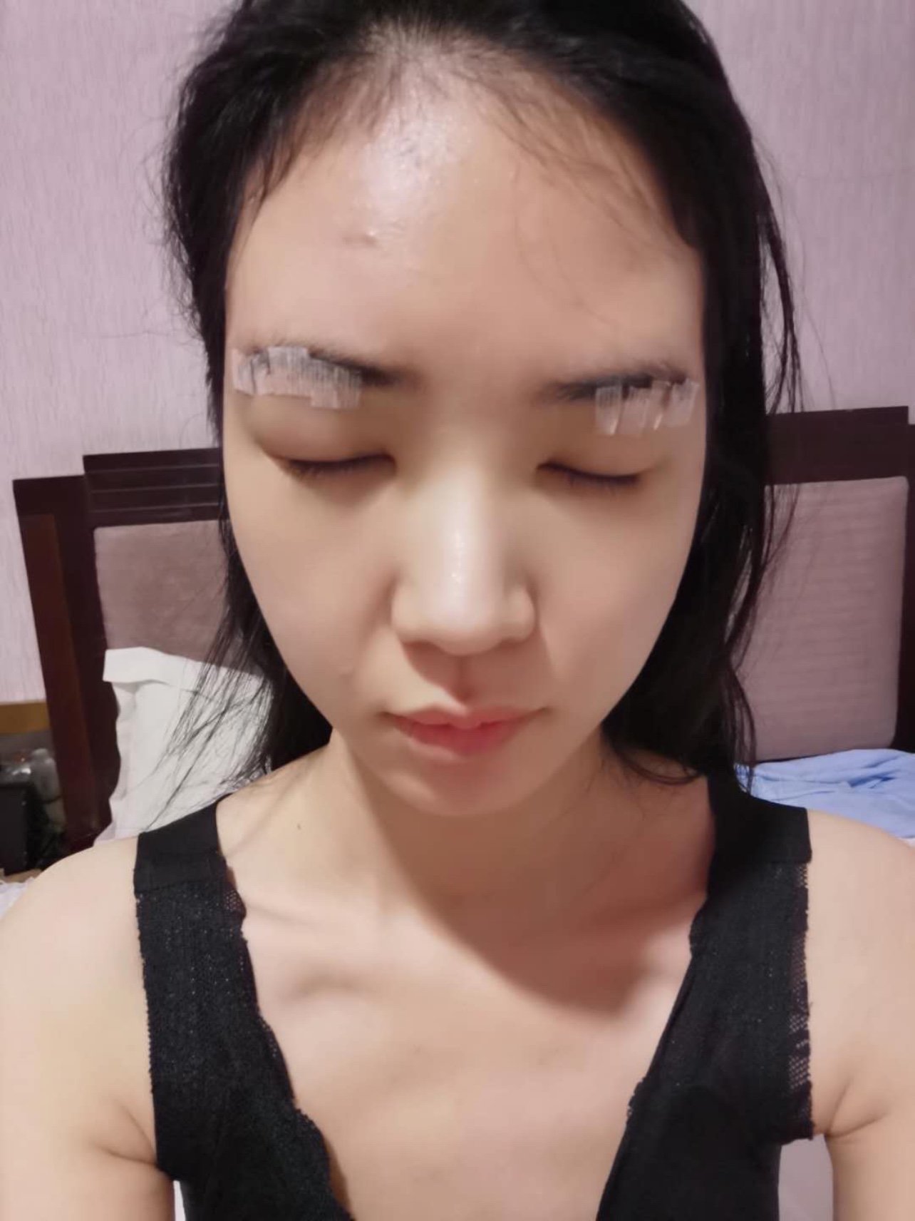 提眉第三天,眼周肿起来了,还有点泛黄#提眉