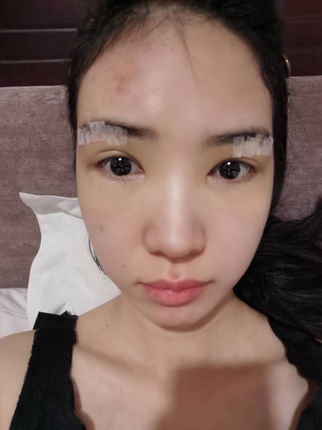 提眉第三天,眼周肿起来了,还有点泛黄#提眉