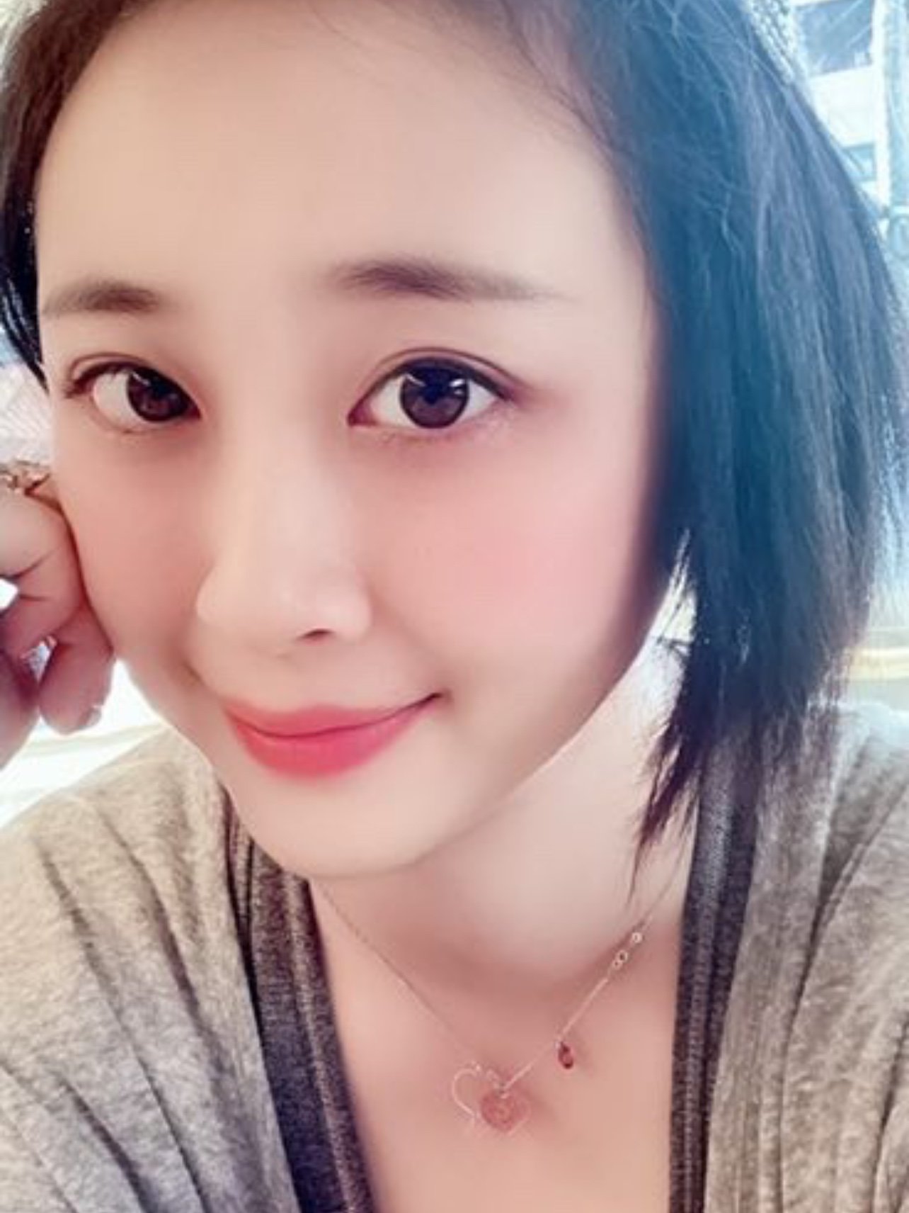 面部饱满:术前凹陷的不像话,术后饱满圆润但也不会显_圈子-新氧美容