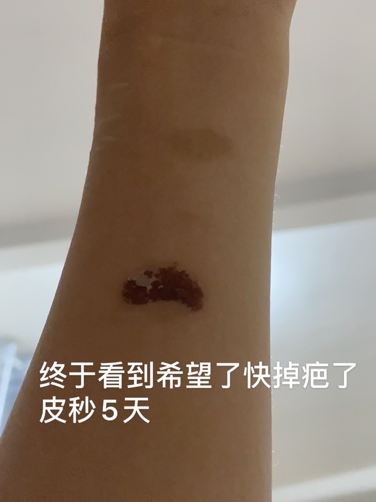 用了各種祛疤膏無解 最後選擇在自己做了果酸刷酸 光子嫩膚皮秒三次