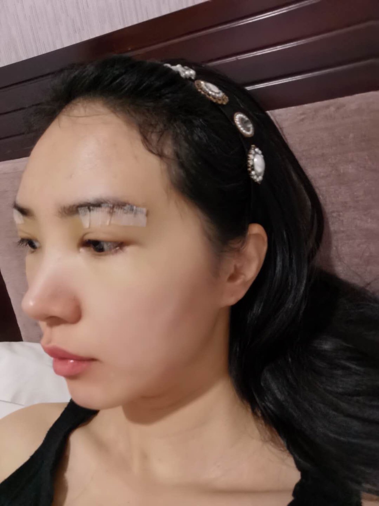 提眉第三天,眼周肿起来了,还有点泛黄#提眉