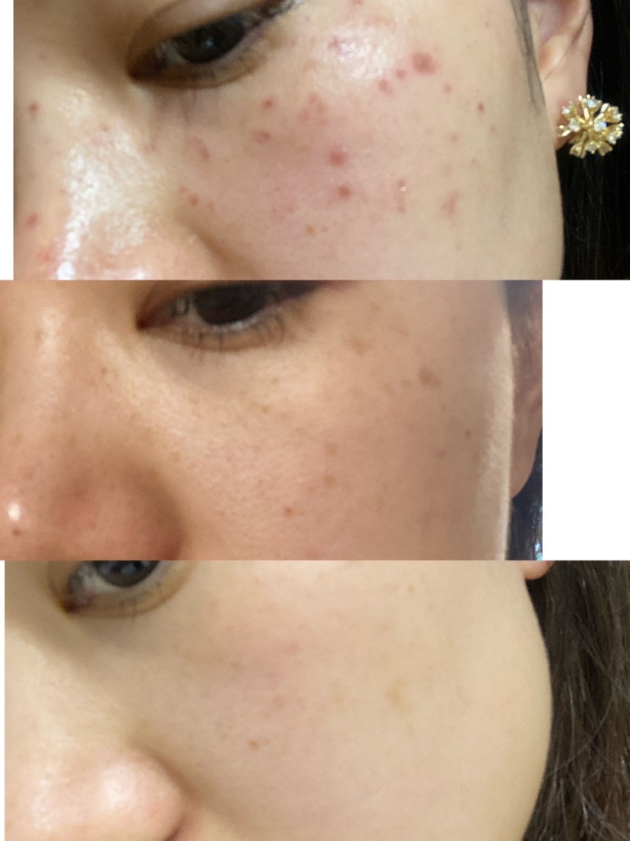 做完皮秒祛斑快两周了,附上这段时间的对比