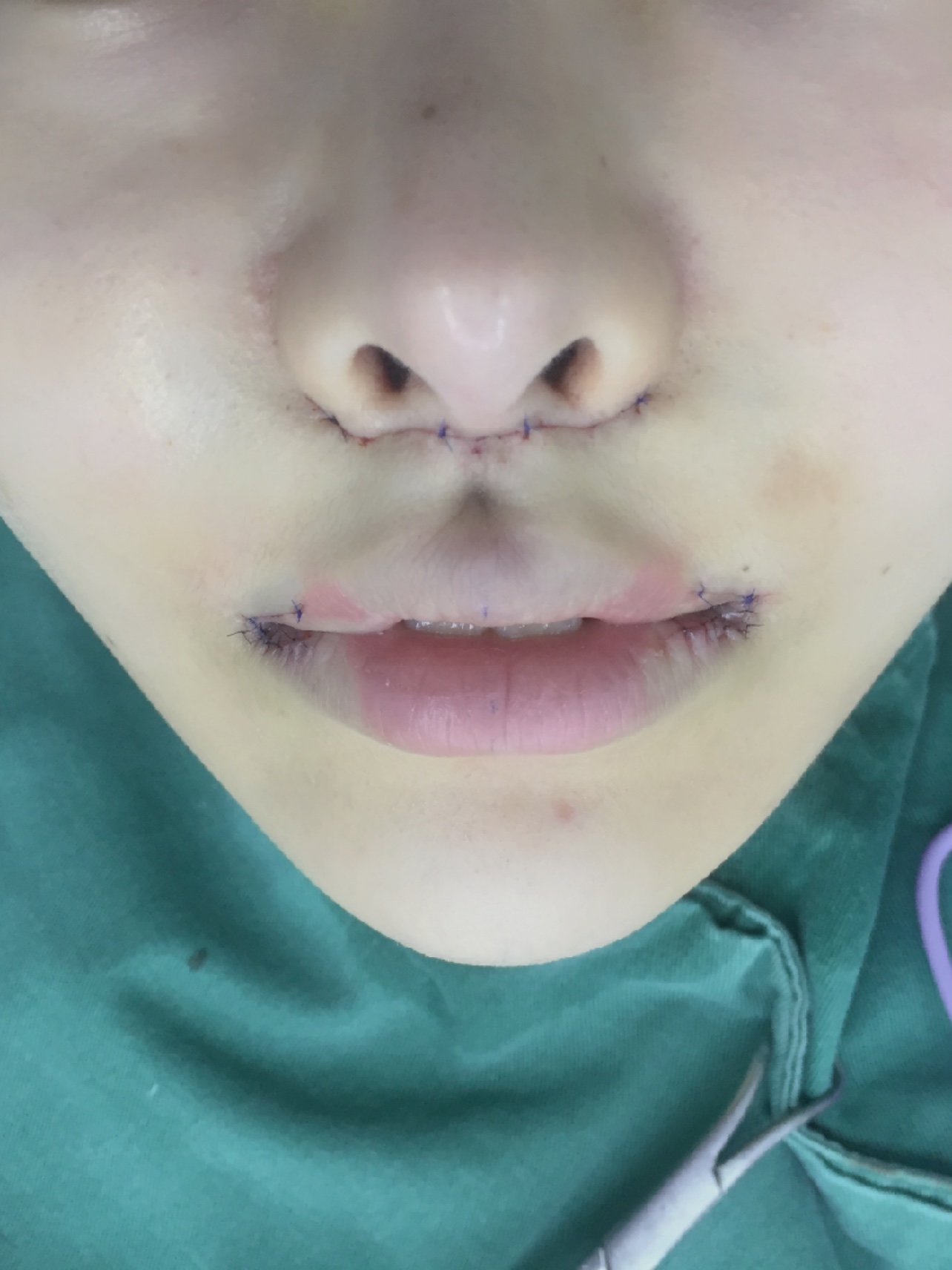 人中缩短再造 上唇改薄术后第一天