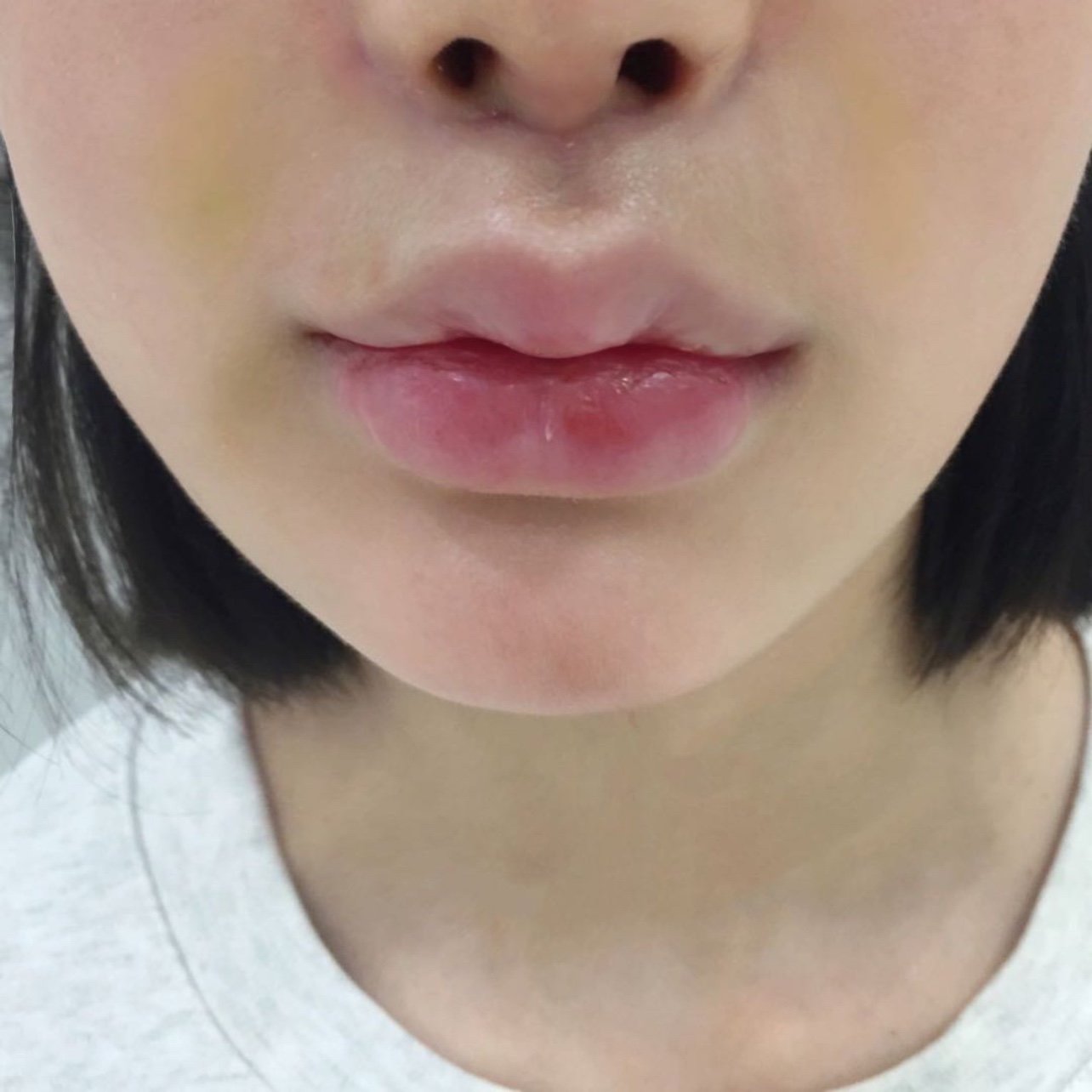 人中缩短77人中加深两项手术都做了,今天是第7天,近_圈子-新氧美容