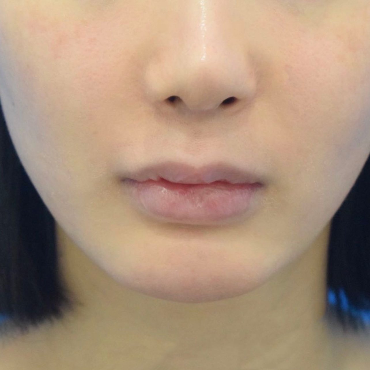 缩短77人中加深两项手术都做了,今天是第7天,近_圈子-新氧美容整形