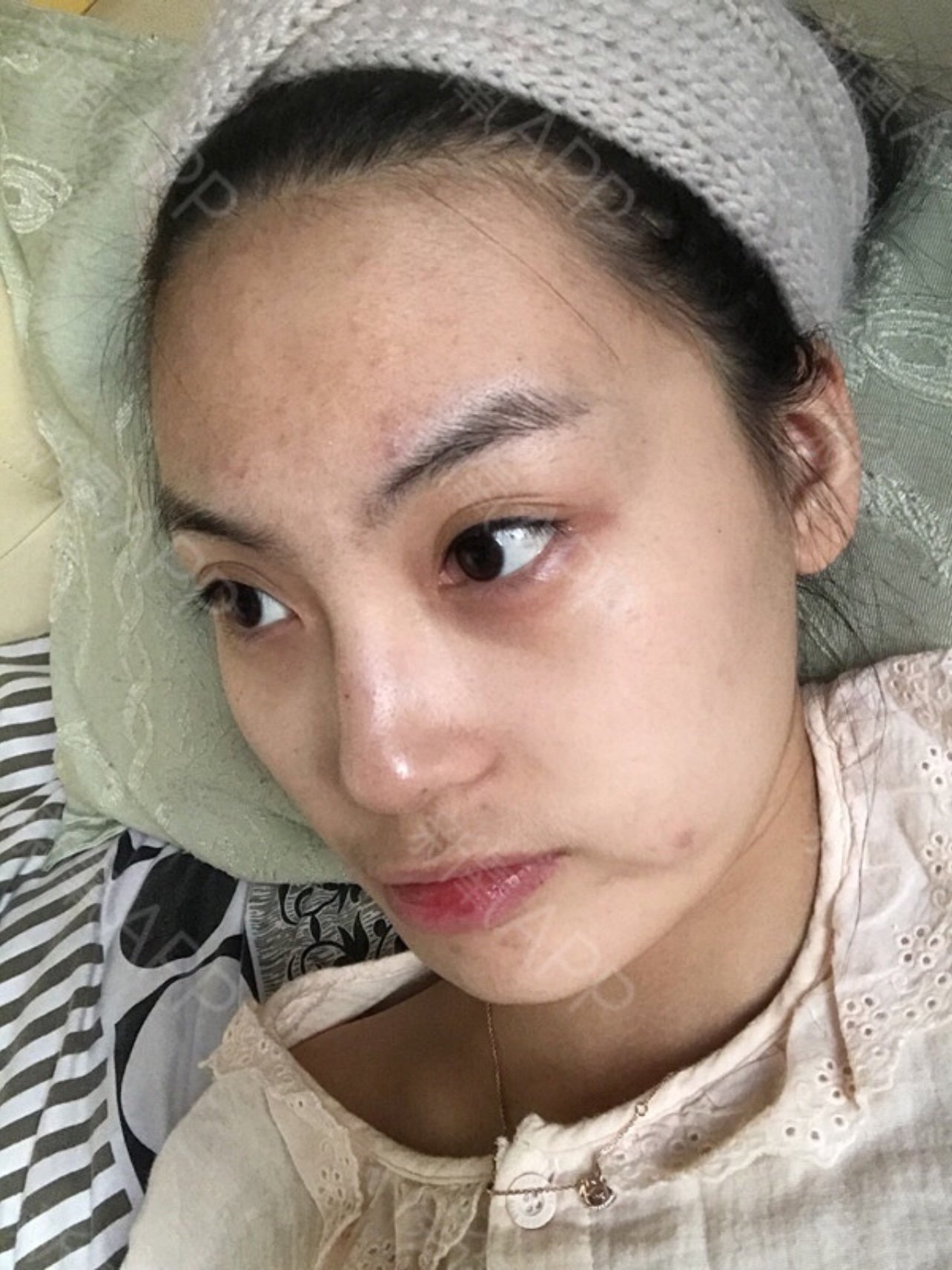 做完线雕的第29天,已经可以肆无忌惮的做任何表情,_圈子-新氧美容整形