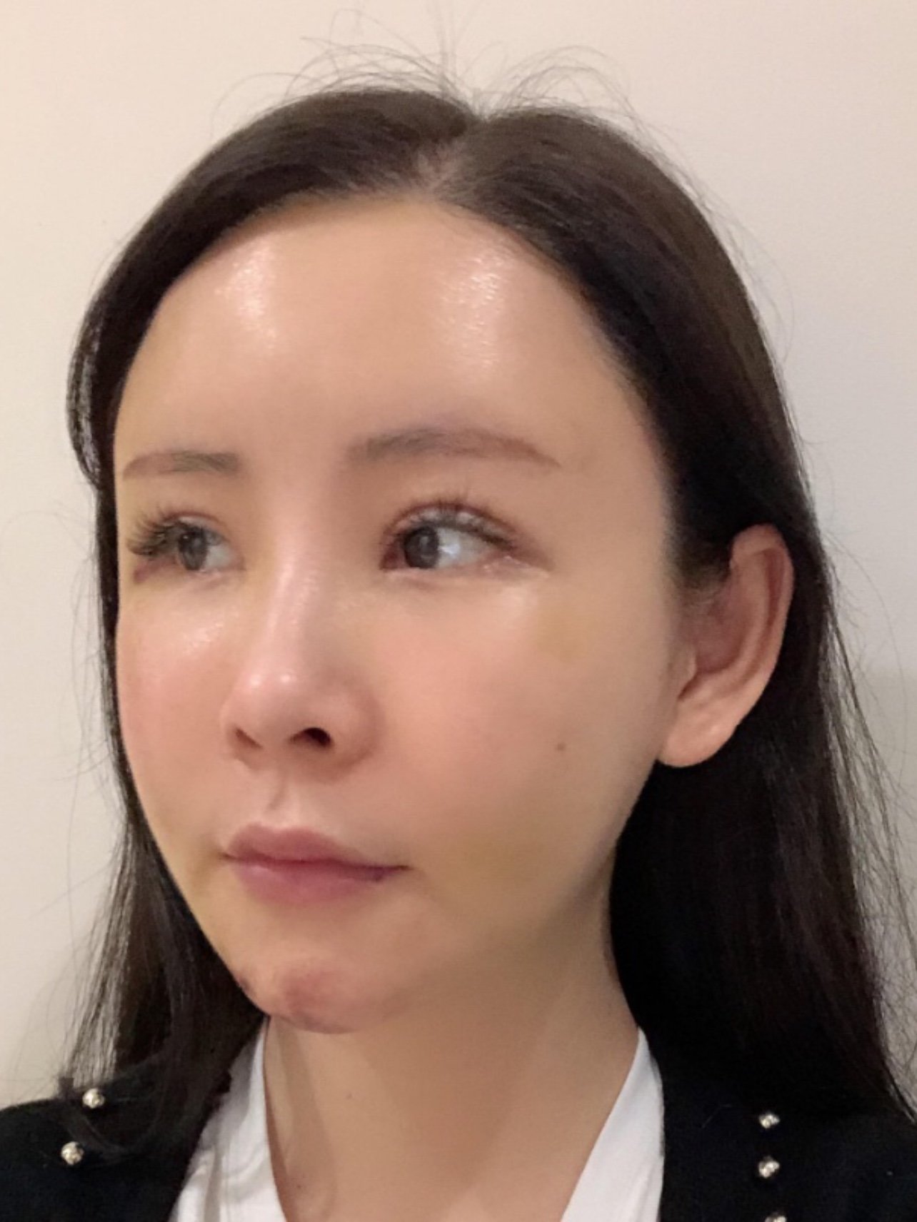 现在脸上的淤青已经渐渐地淡了下去了,只是下巴上的淤_圈子-新氧美容
