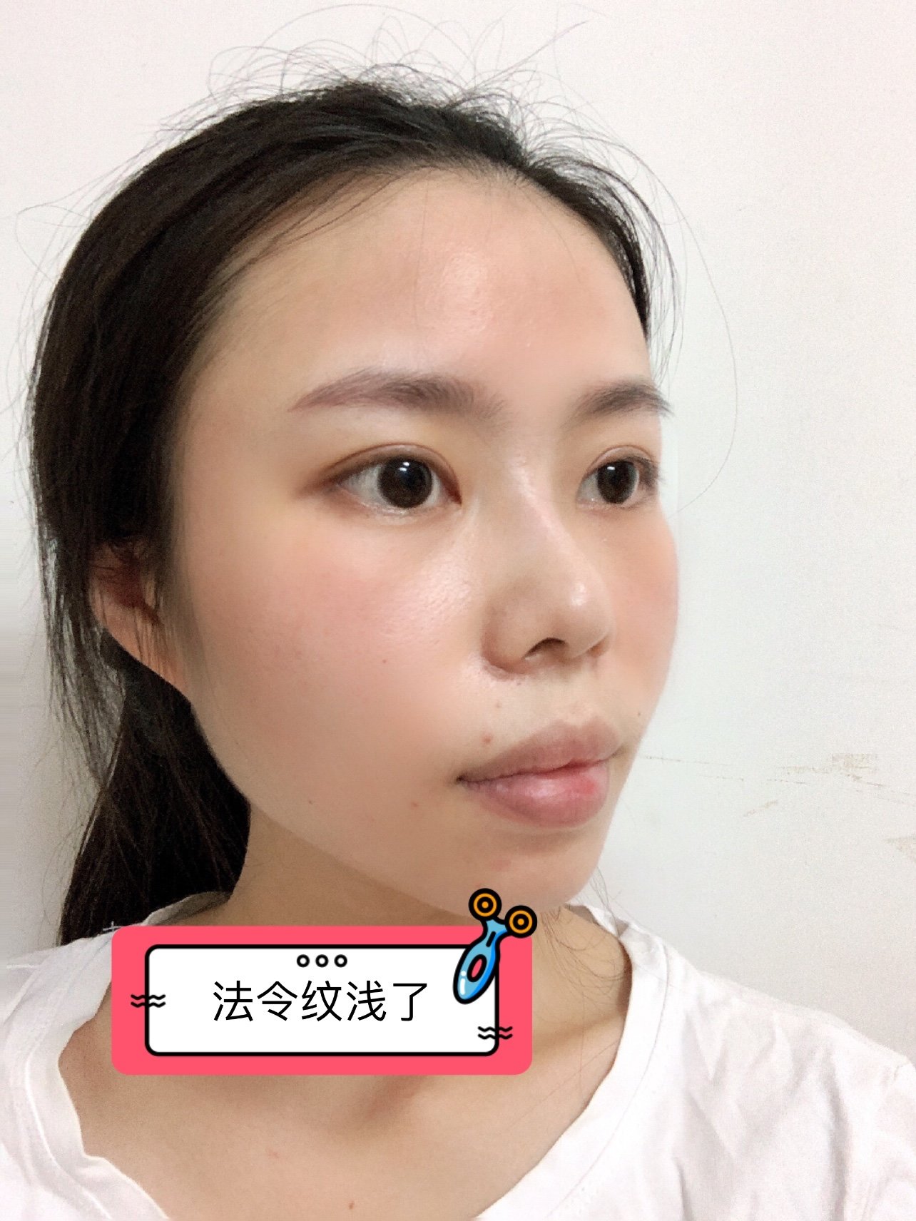 术后3天基本是上不怎么红了,确定法令纹变浅了,太太_圈子-新氧美容