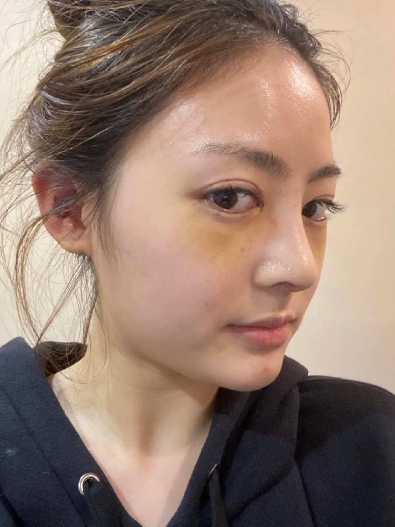 自然款鼻子,相对于过去没有什么惊人的改善,整体看着_圈子-新氧美容
