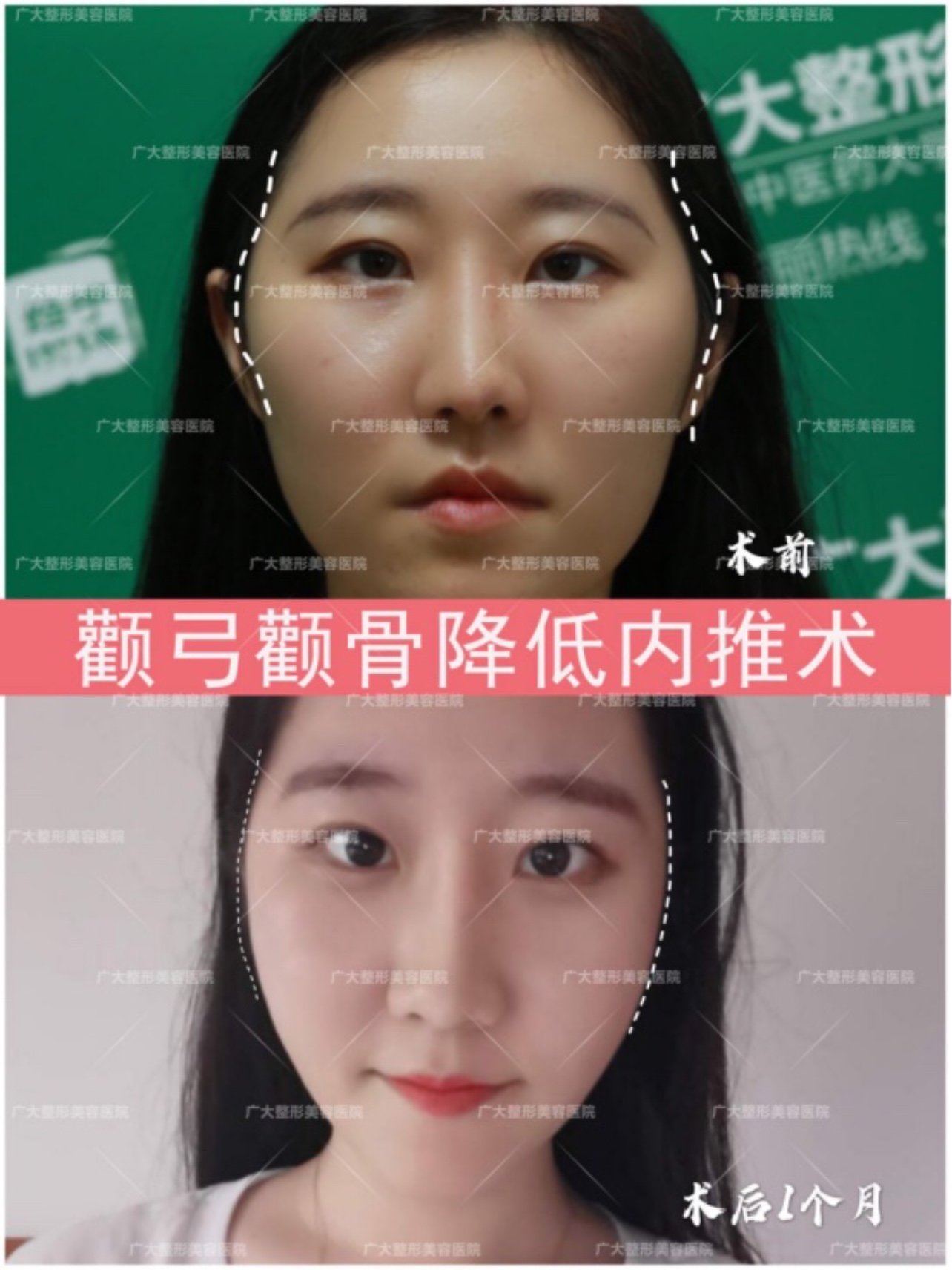 【术前诊断】:这个顾客颧骨颧弓突出,导致面部轮廓线_圈子-新氧美容