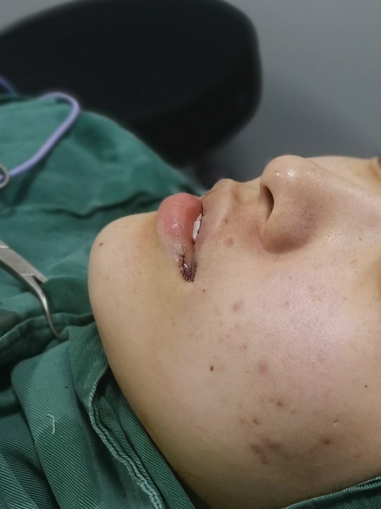 我的嘴巴比较厚,嘴唇没有唇形,为了让大家更清楚的看到,特意在手术