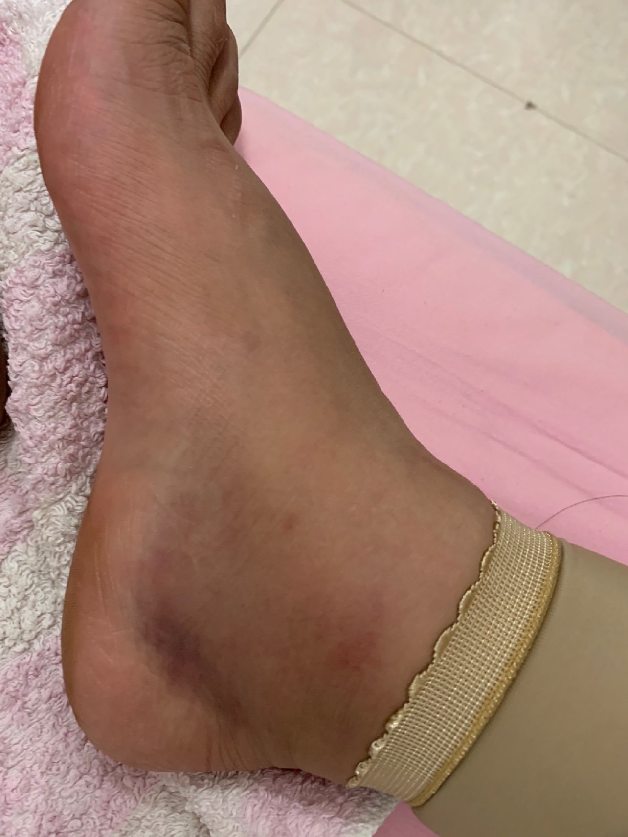 脚背肿得只能穿男士拖鞋了.