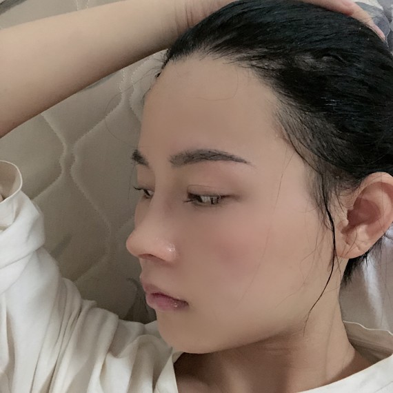 我的鼻子也是,现在一个月了,感觉鼻头好尖,跟鸟人一样,请问你后期鼻头