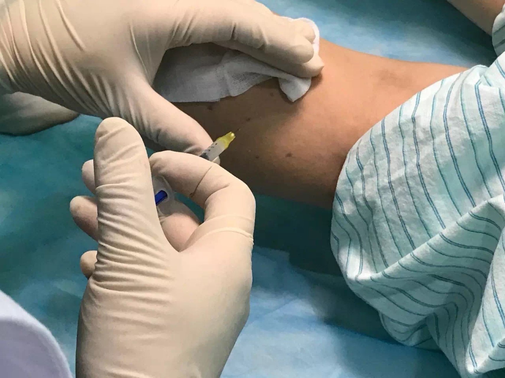 感觉打完还是有一些变化的,特意让朋友帮我拍了注射的_圈子-新氧美容