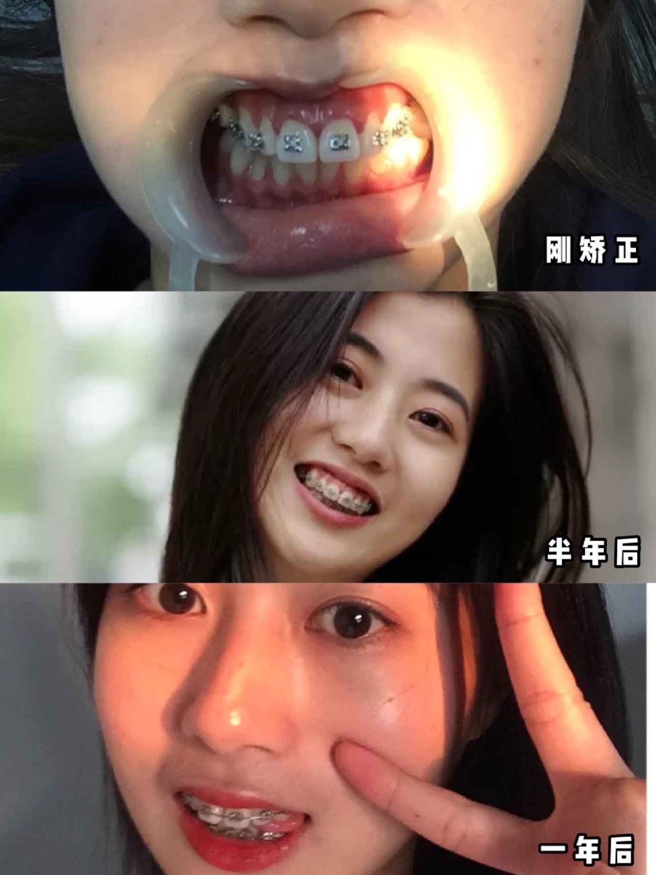 龅牙对脸型的影响图图片