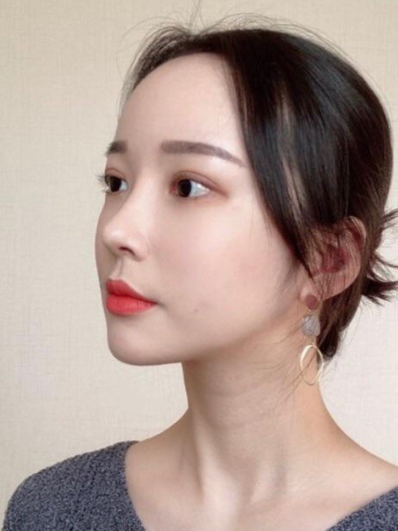 填充了苹果肌,效果真是杠杠的好,特别好看了