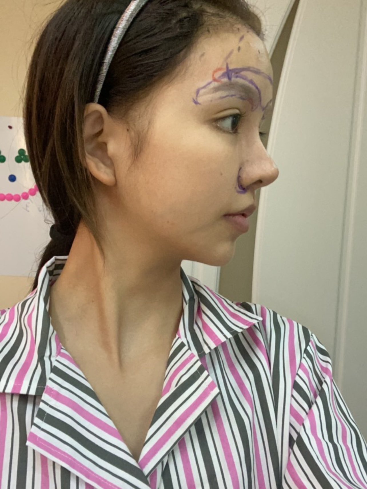 膨体垫鼻基底第一天手术医院:北京微美整形医疗美容手_圈子-新氧美容