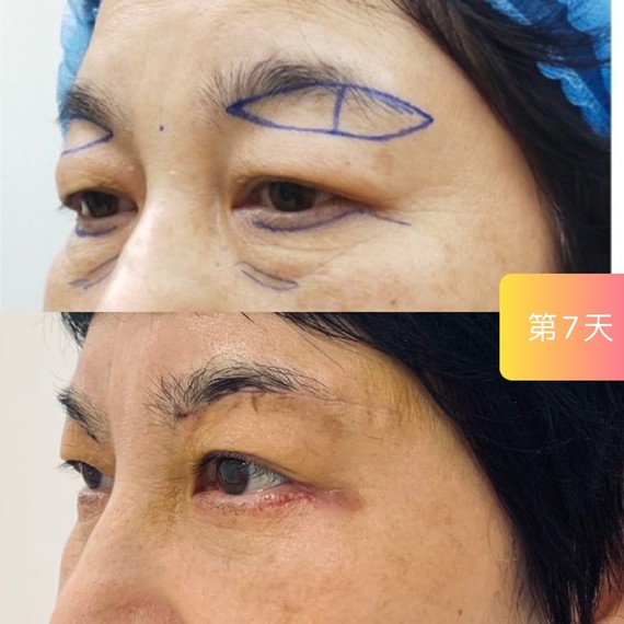 提眉 外切祛眼袋第7天
