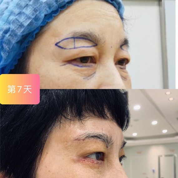 提眉 外切祛眼袋第7天