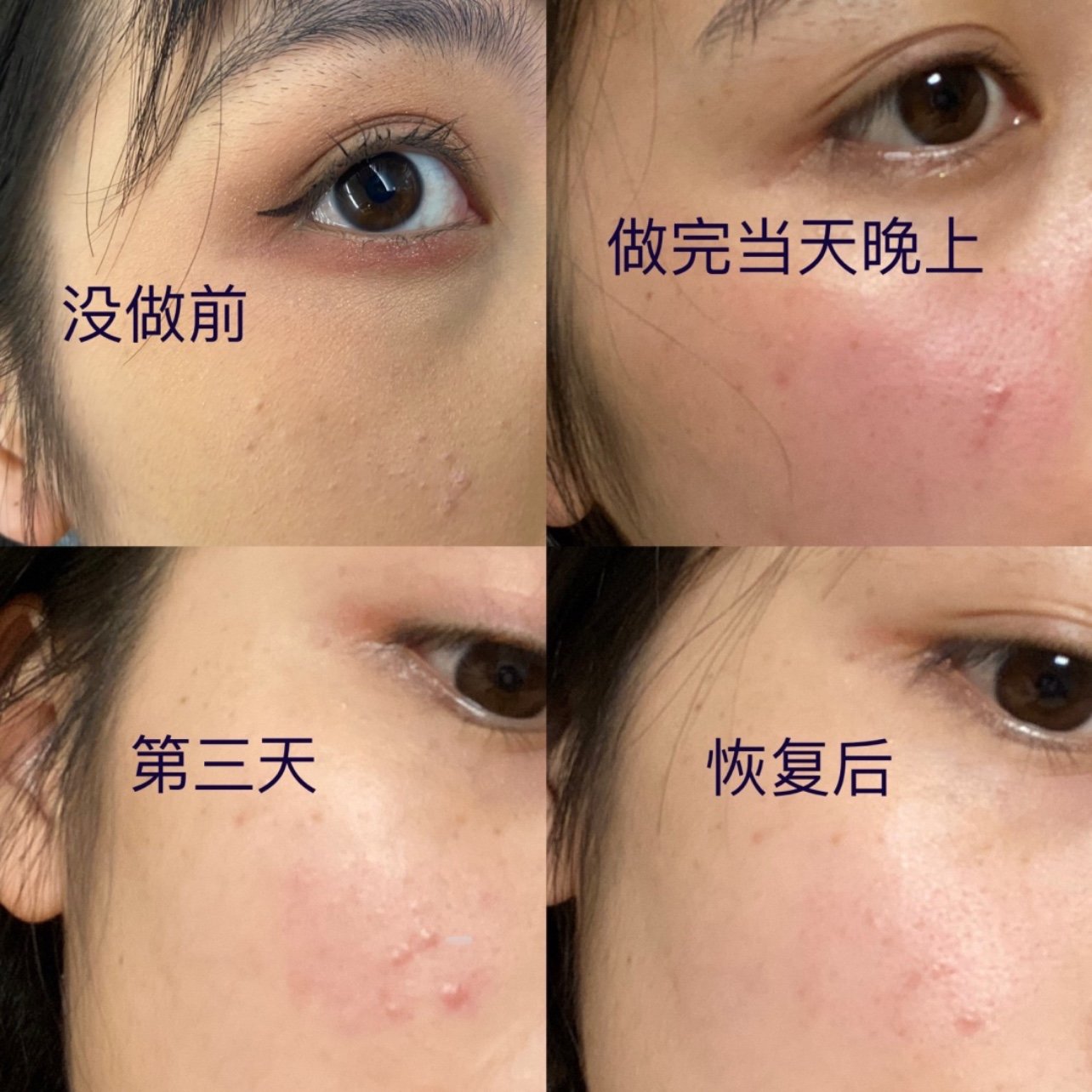 医美/滚针/微针/区别滚针和微针叫法其实都一个样图_圈子-新氧美容