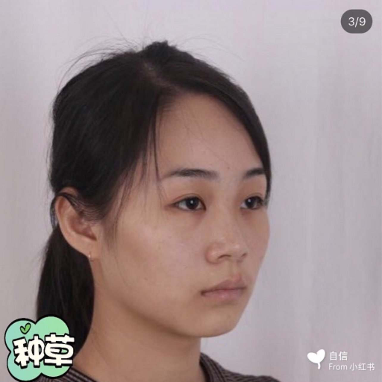 从小鼻子就不好看,鼻子太扁平了,毫无立体感,长大后越看自己越觉得不