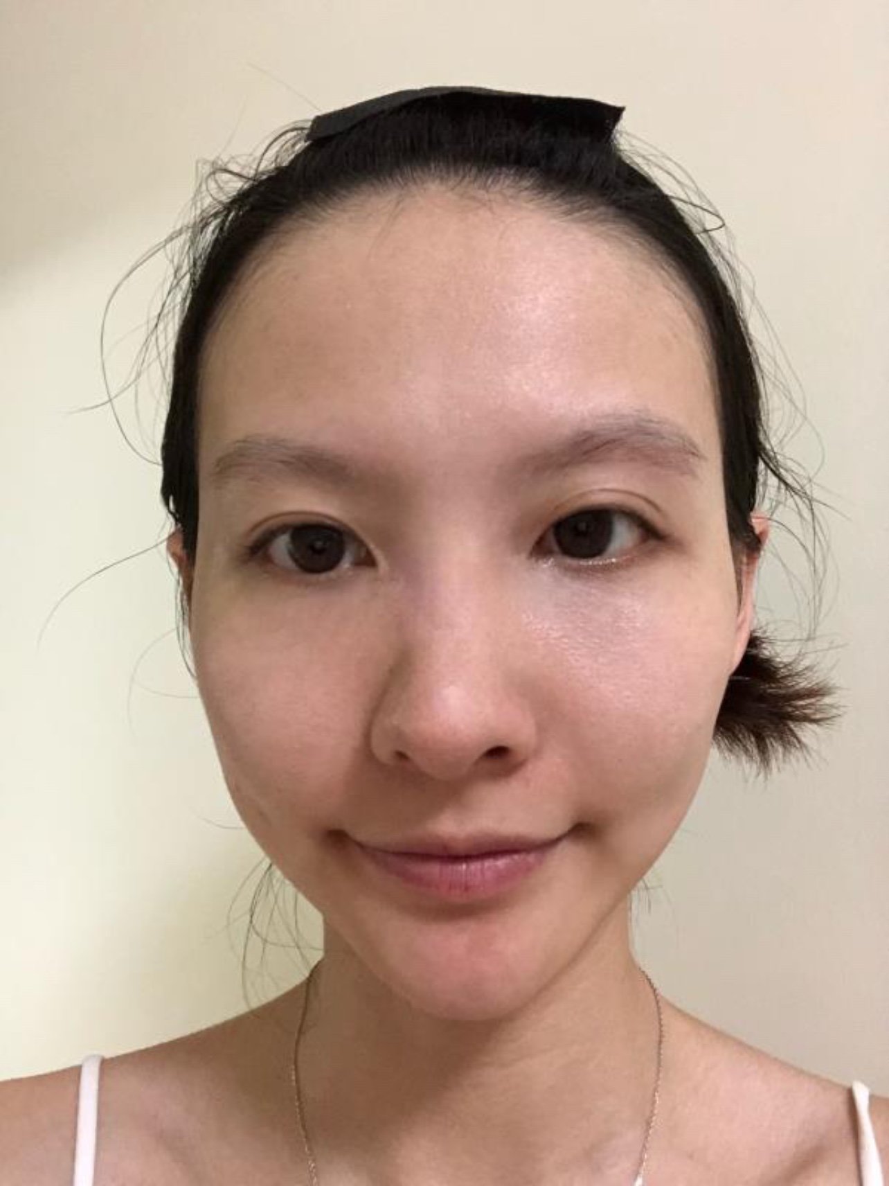 27岁以后,皮肤明显下垂,从事服务行业的我深知形象有多重要,虽然月薪