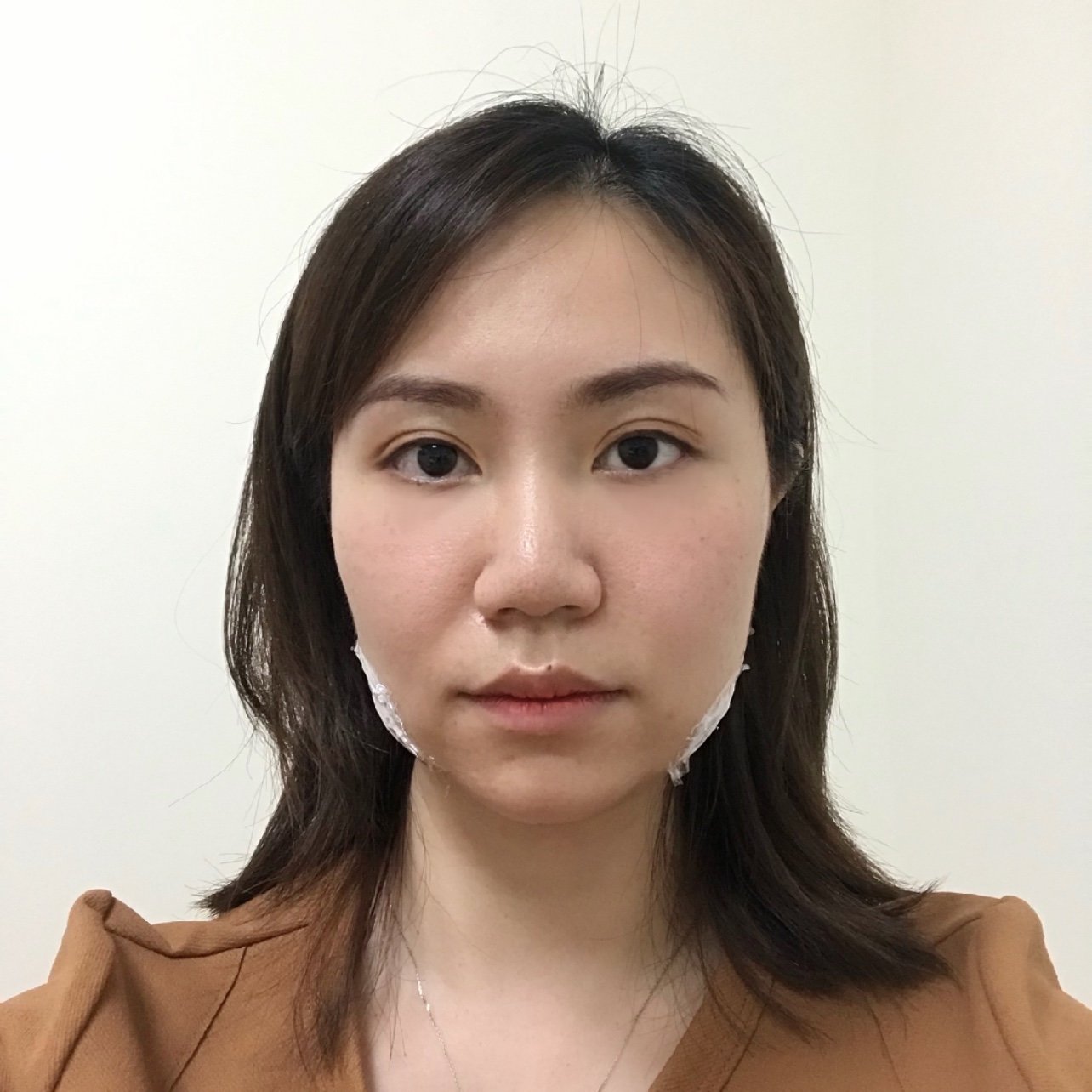 新氧体验官 瘦脸针[:76]随着年纪增大脸上发腮_圈子-新氧美容整形