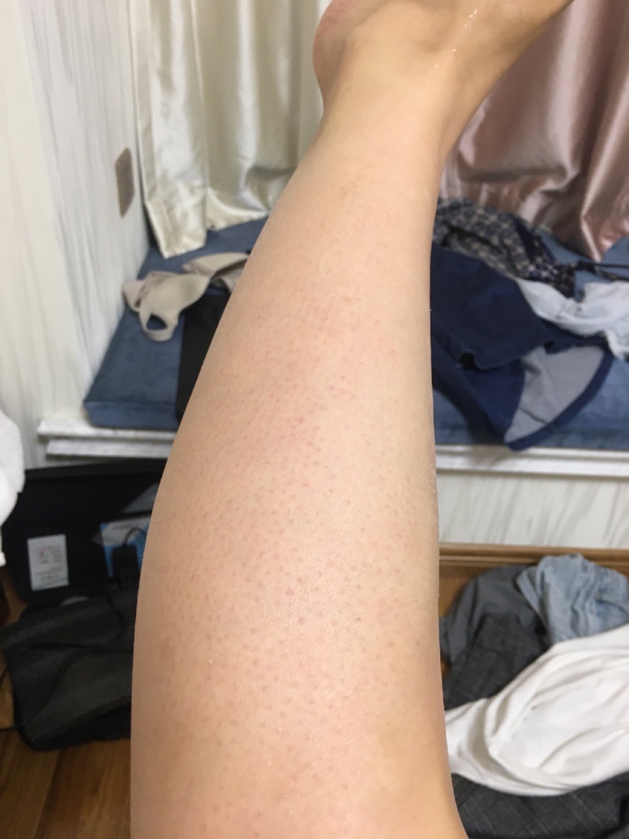 都是鸡皮 用的是博乐达水杨酸30%浓度  脸已经刷了三四次了 脚第一次