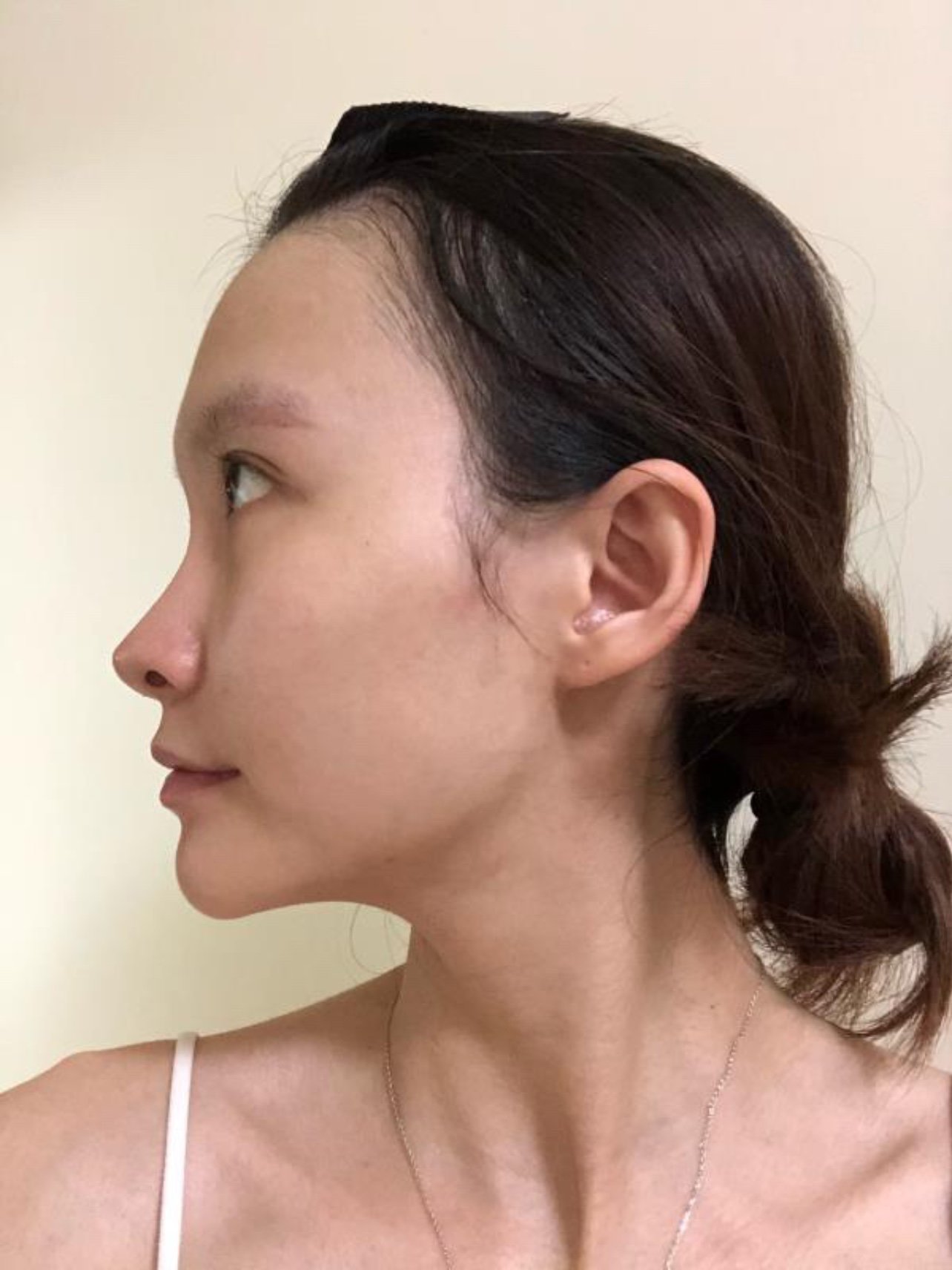 27岁以后,皮肤明显下垂,从事服务行业的我深知形象有多重要,虽然月薪