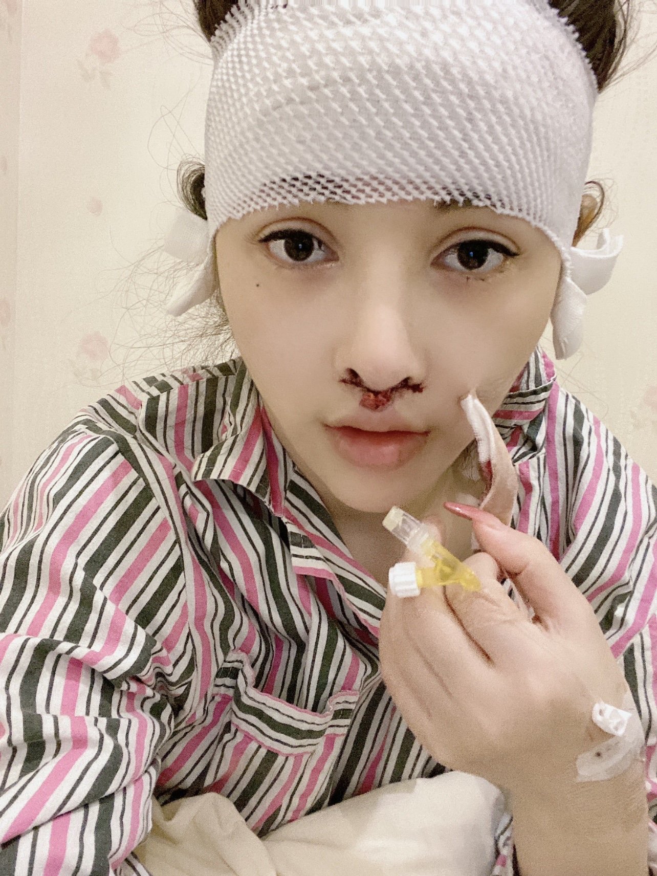 人中缩短77人中沟加深第1天