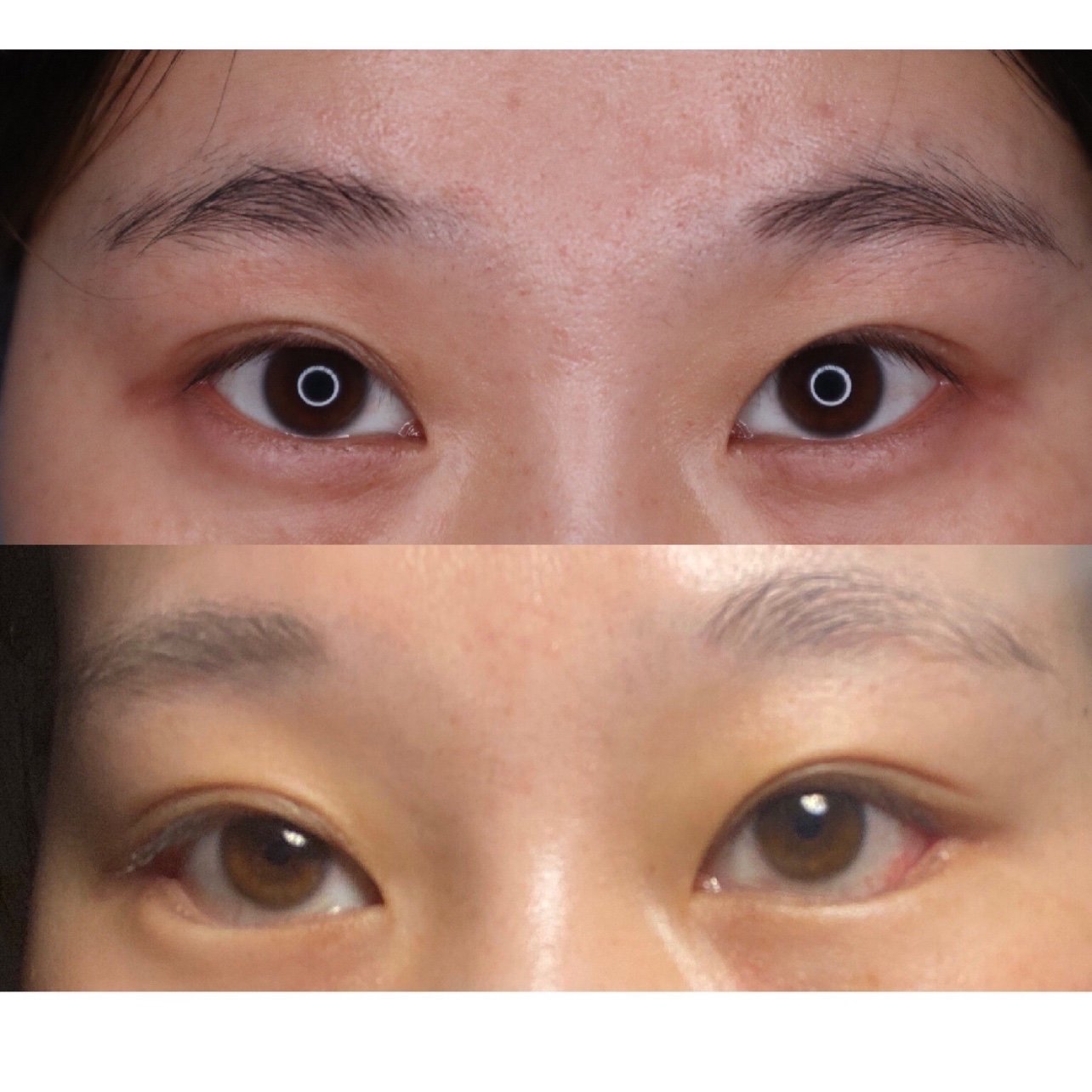 下睑下至 外眼角王皓民术后15天,每天都在祈祷 回缩慢一点@王皓民