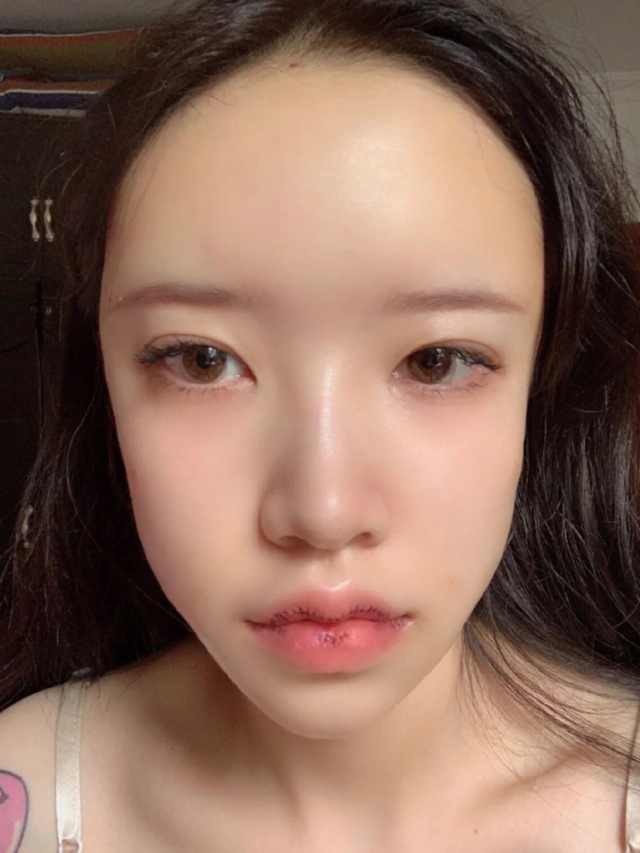 后第2天小时候因为自己的嘴唇厚,很是自卑,拍照都_圈子-新氧美容整形