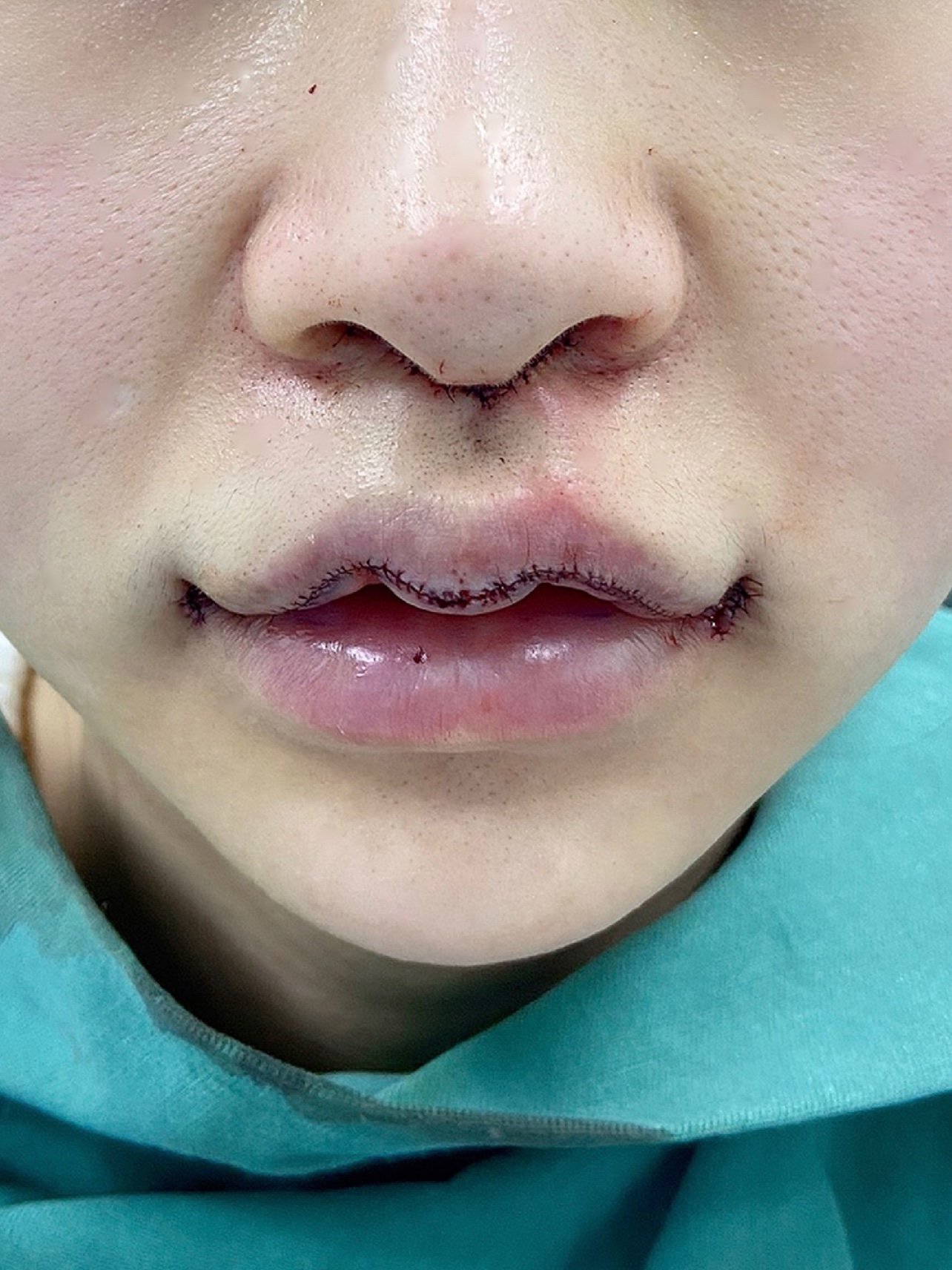 【人中缩短术】人中偏长/人中缩短隐痕第三代/幼态减龄/隐形切口