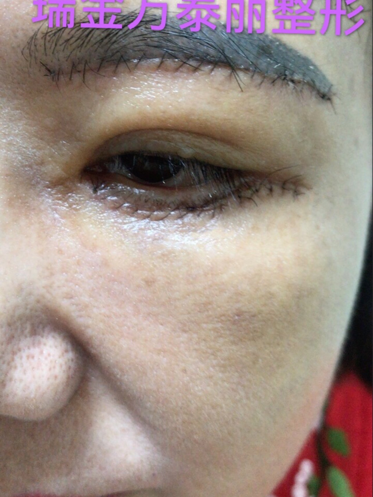 筋膜悬吊提眉77眼袋综合:去除鱼尾纹,眼袋紧致的如少_圈子-新氧美容