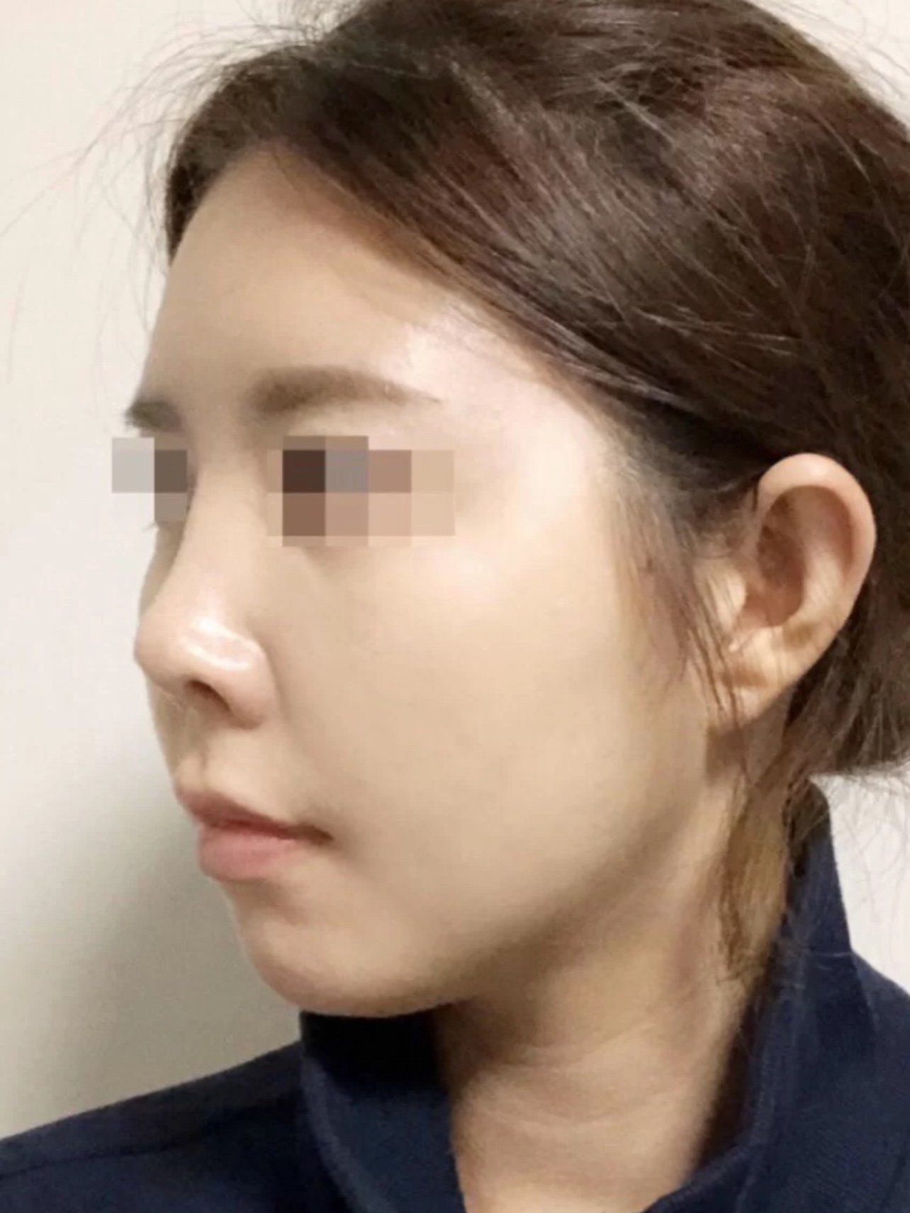 种草/避坑,最近你做的医美项你知道你的鼻子怎么分_圈子-新氧美容