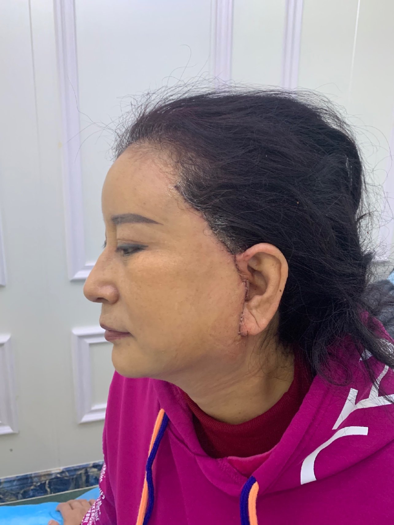 微创拉皮手术前,术中及术后一天效果,无痛微创,不剥_圈子-新氧美容