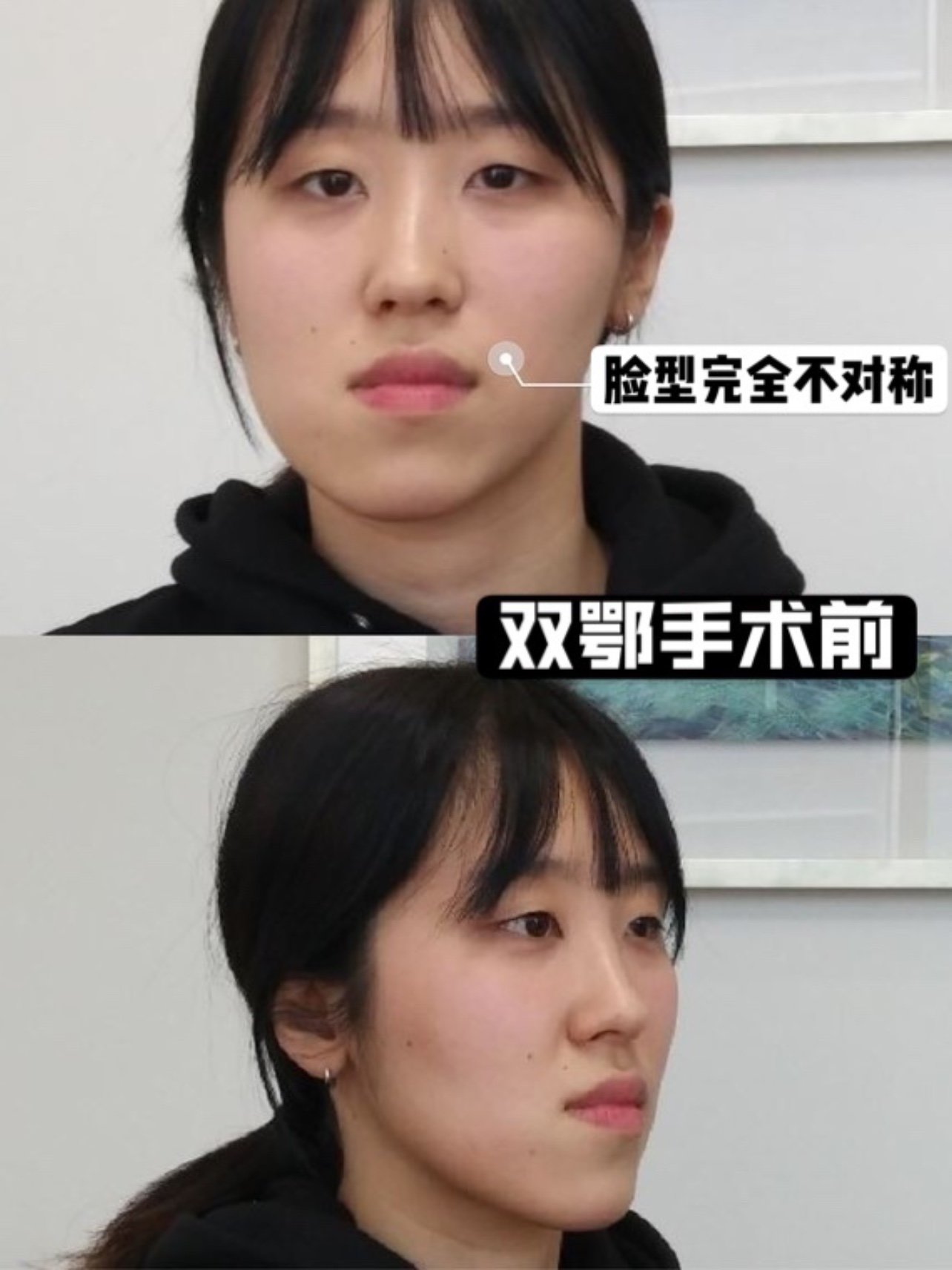 96之前的奇葩整形故事讲过韩国那边双鄂手术的案例(可_圈子-新氧