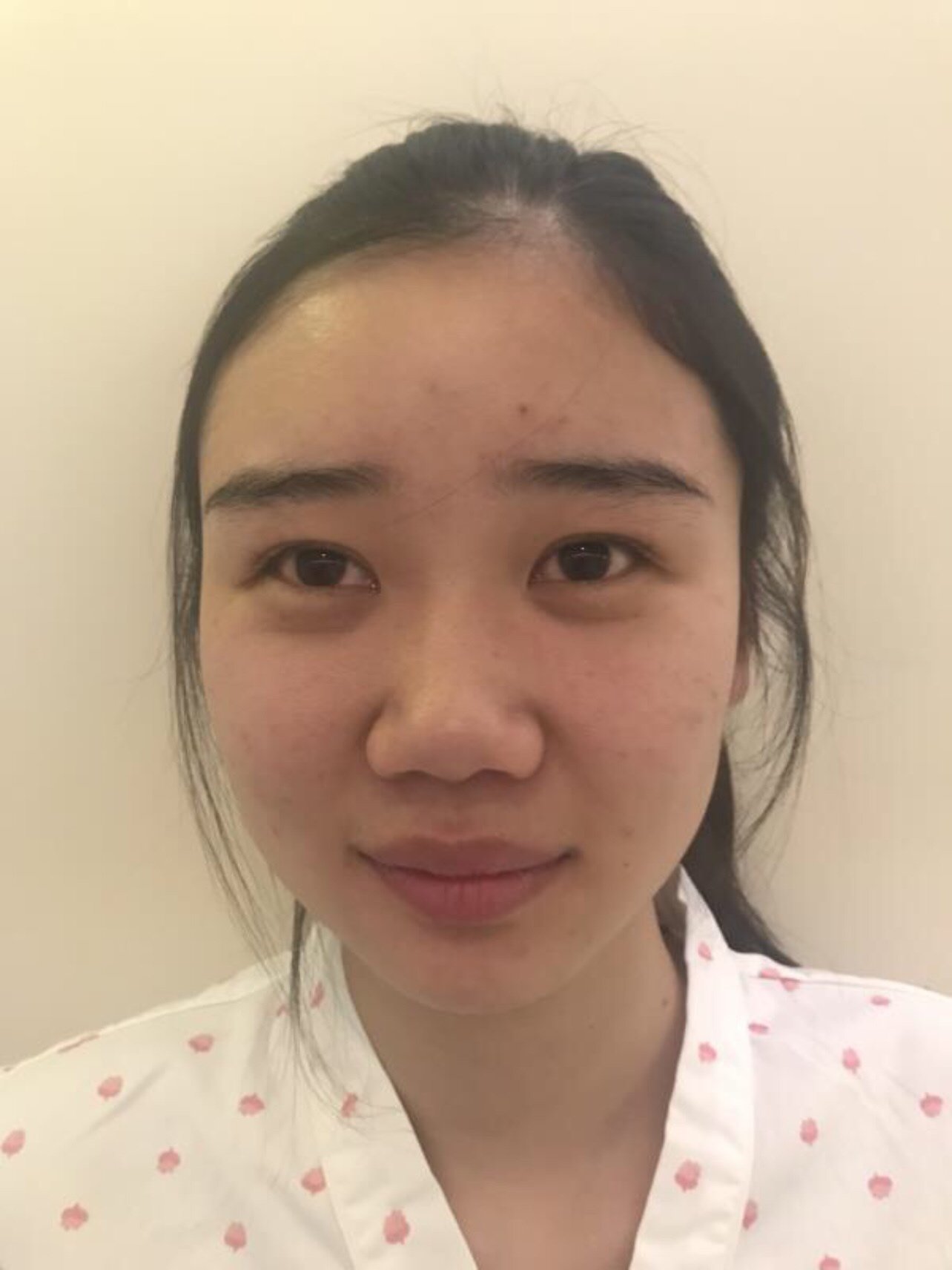 我我的鼻子在没做之前是非常难看的比量,他鼻子扁平显_圈子-新氧美容