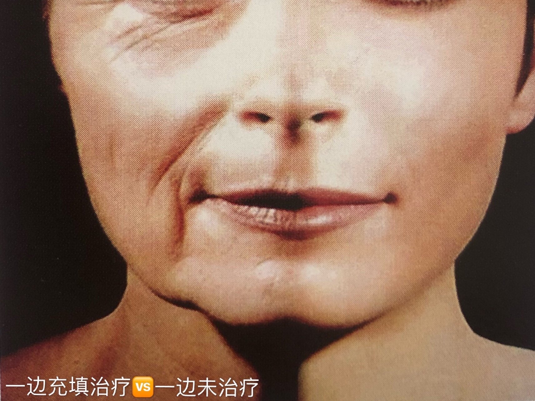 中面部老化松弛的原因包括皮肤老化,脂肪萎缩,韧带松弛,肌肉松弛,骨或