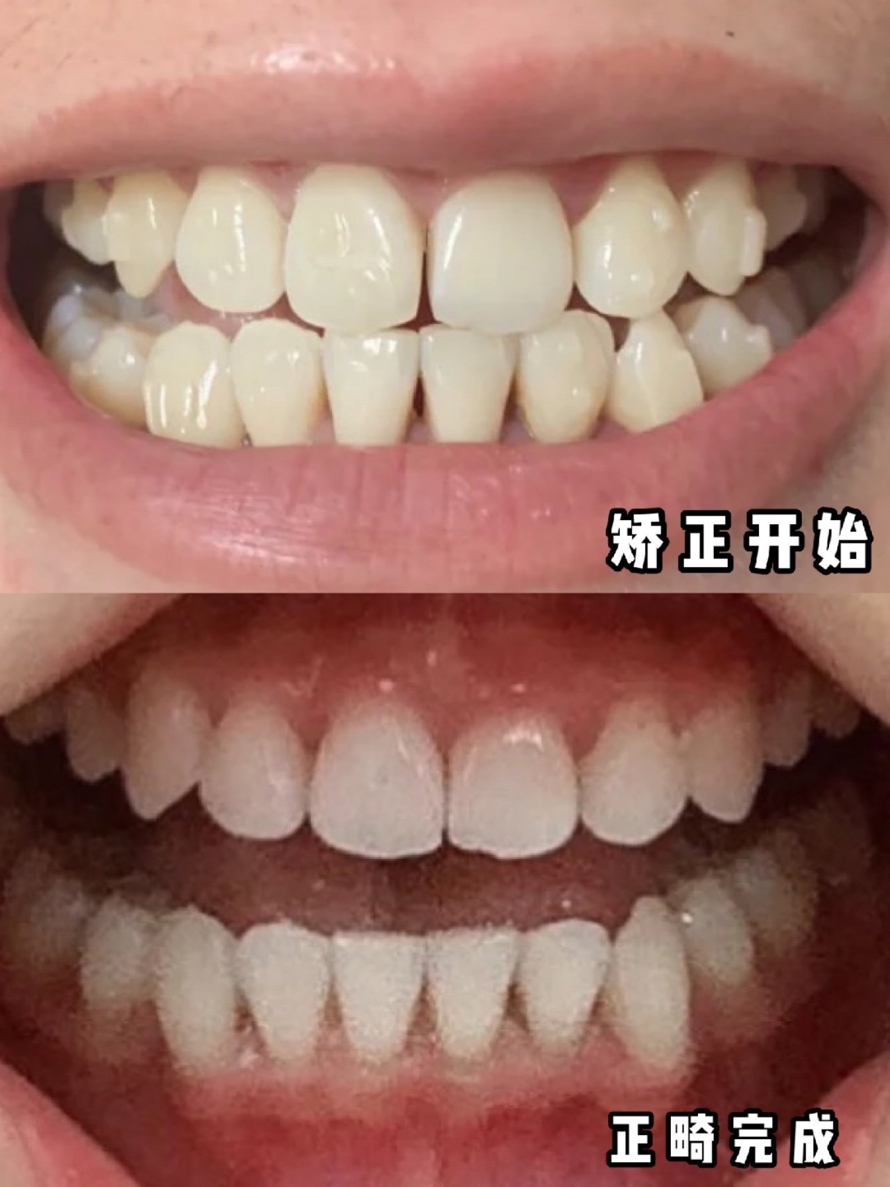 一年多变化对比,给戴牙套的你一点信心!