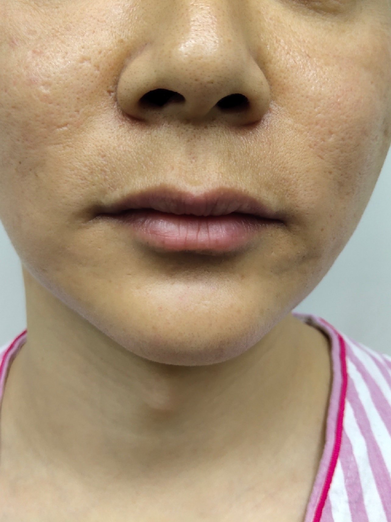 90人中缩短做完第一天啦,从来没有接触过医美形项目,_圈子-新氧美容