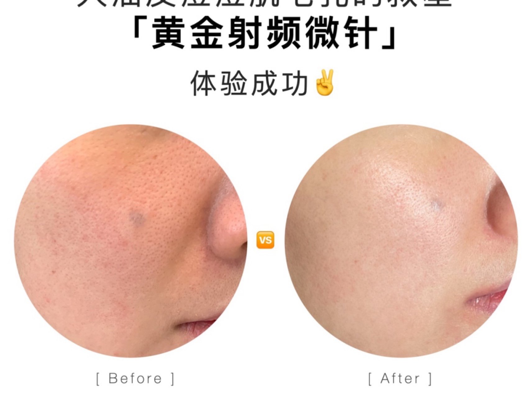 护肤体验·黄金射频微针~粗大毛孔救星