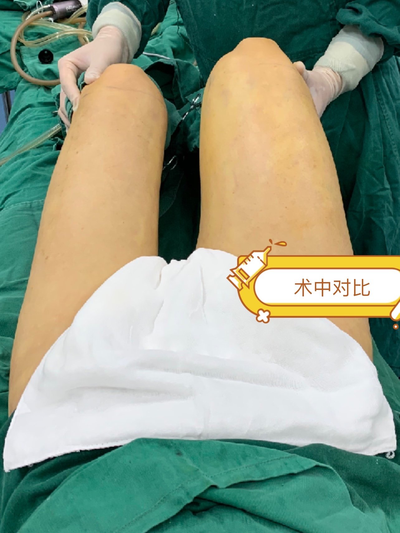 人魚體雕大腿吸脂塑形