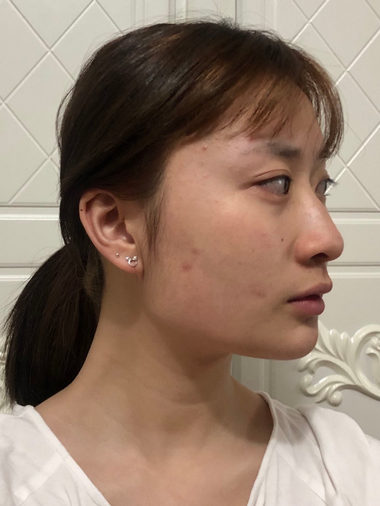 术前脸看着比较方,是典型的骨骼型脸大脸宽,手术后脸_圈子-新氧美容