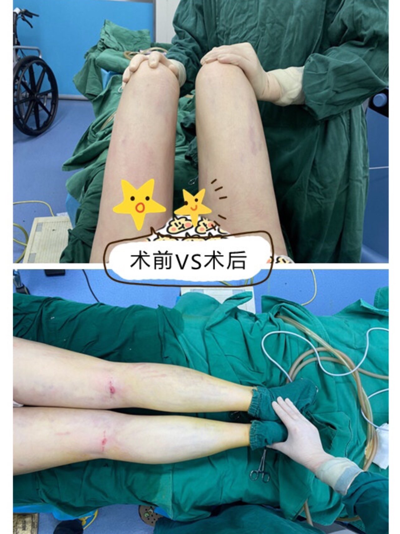 【人鱼体雕大腿吸脂塑形】我的大腿术前腿围是55cm