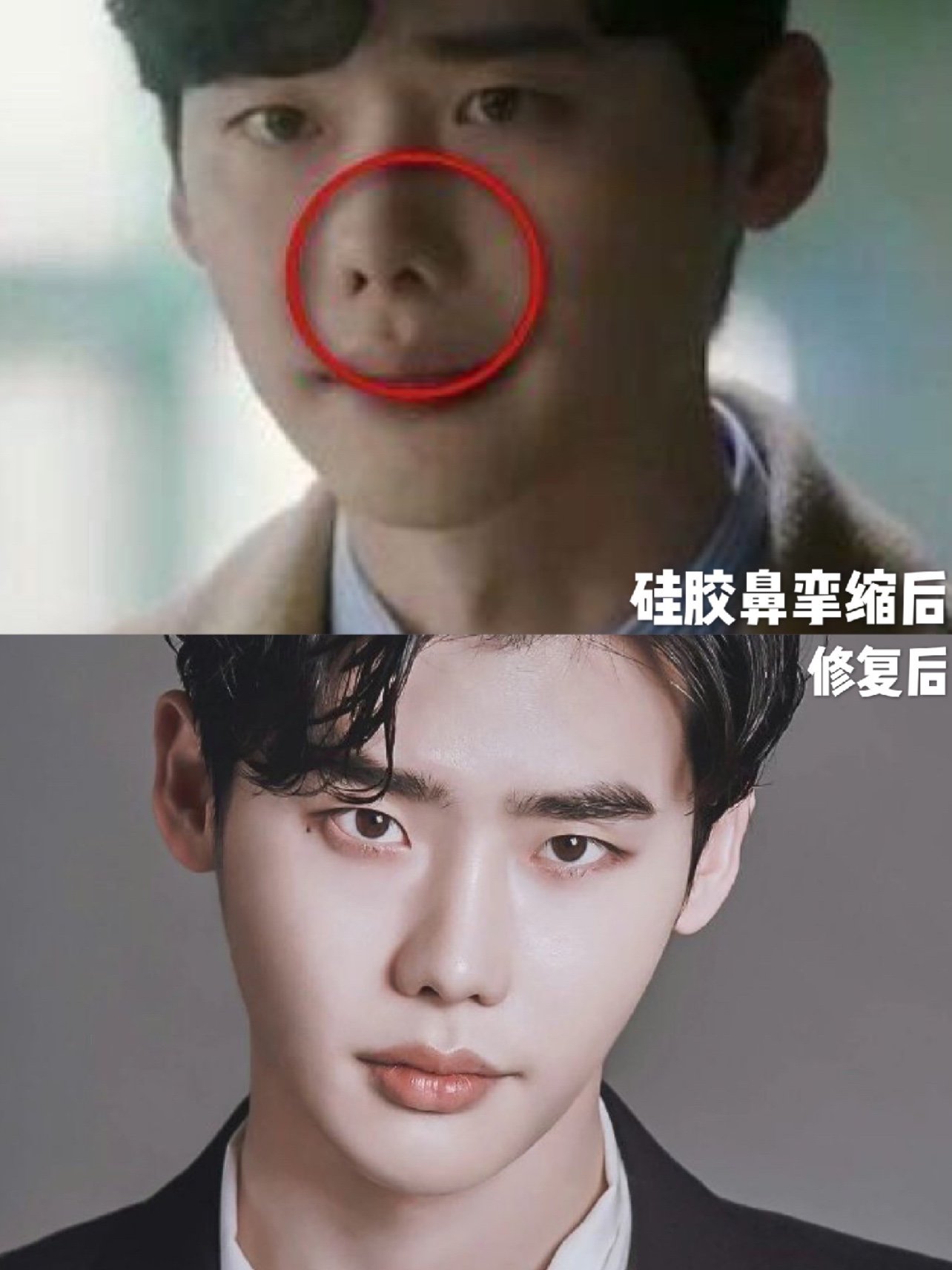 硅胶吧怕透光,怕挛缩成猪鼻子膨体又担心感染,所以也有人干脆不选了