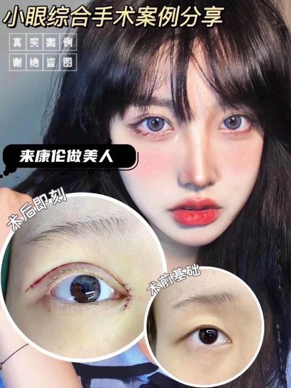 康伦整形78帕克媚眼术98外切下至现场对比效73棒棒哒弧_圈子