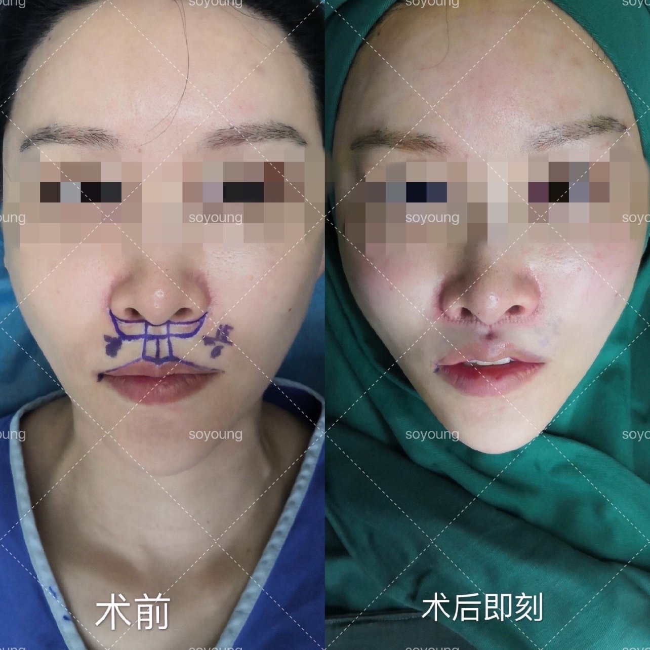 我的人中不仅长而且歪,特别的影响形象,小的时候还好_圈子-新氧美容