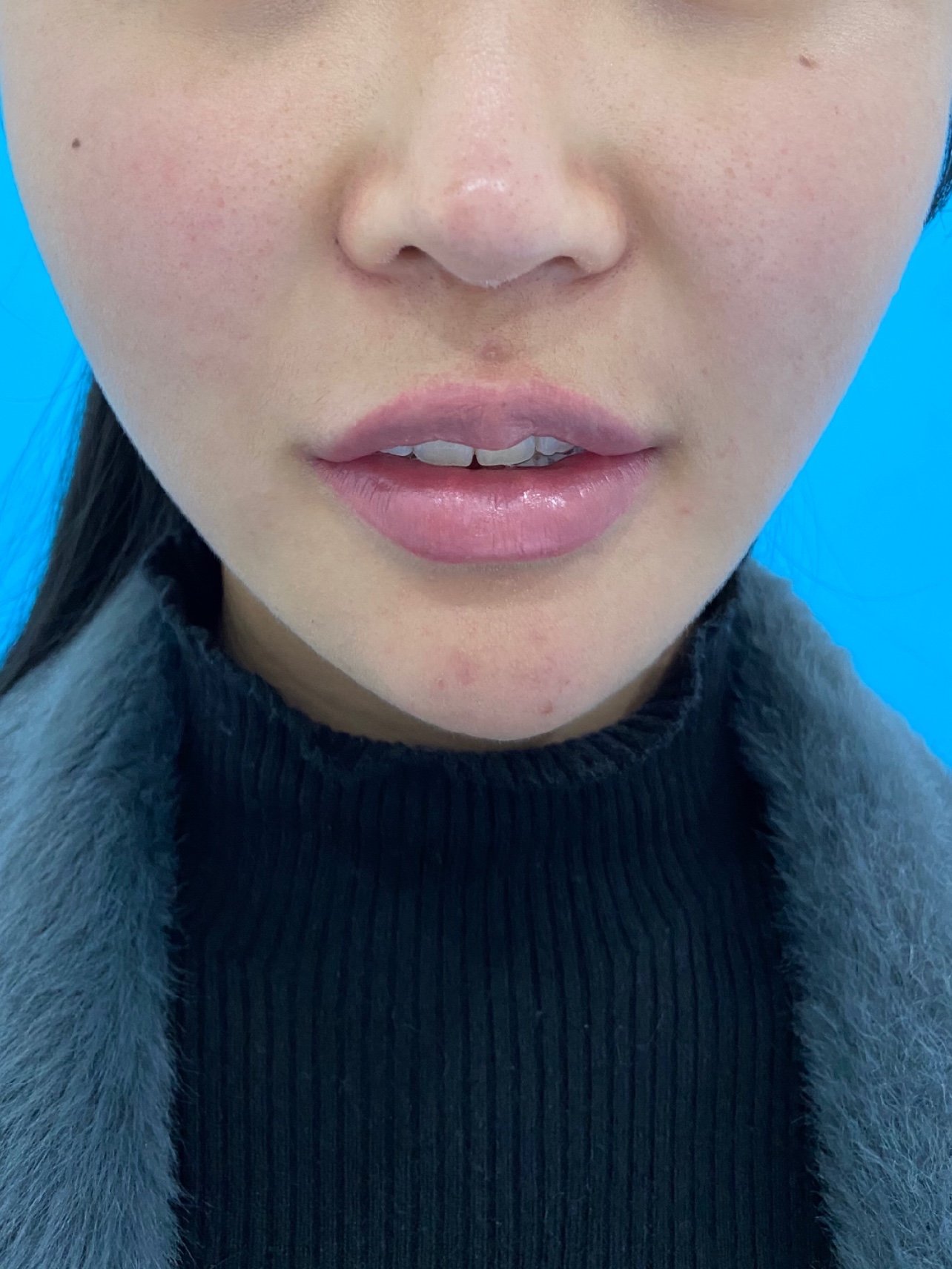 【人中缩短术】人中偏长/人中缩短隐痕第三代/幼态减龄/隐形切口